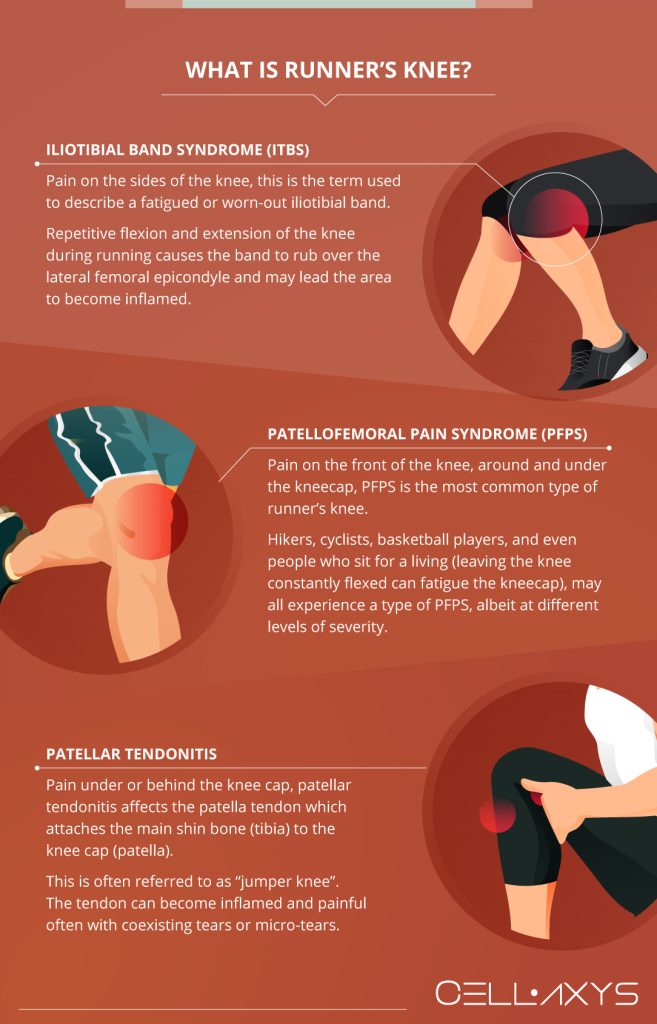 Can runner's knee be permanent?