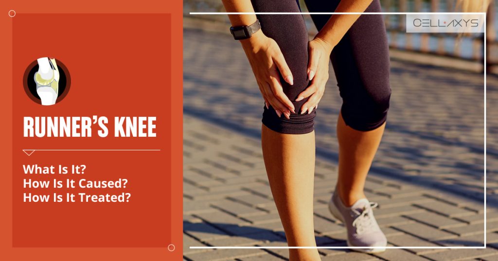 Runner’s Knee