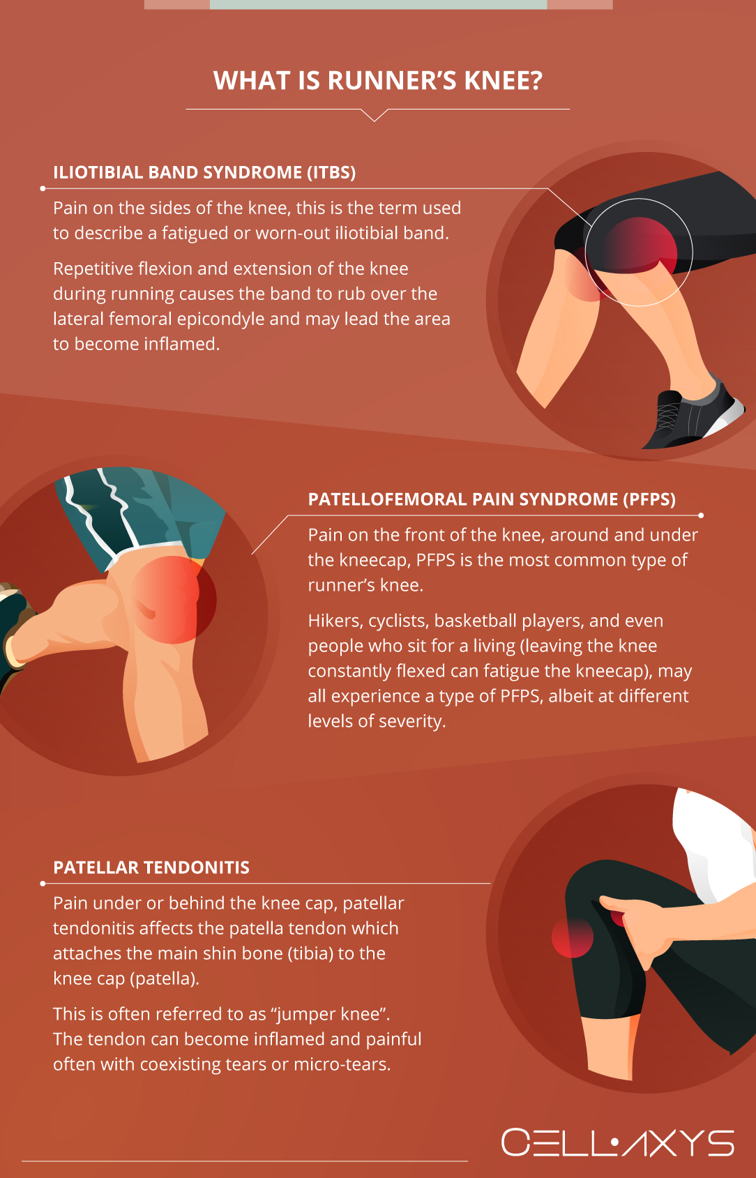 Runner's Knee: What Is It? How Is It Caused? How Is It Treated