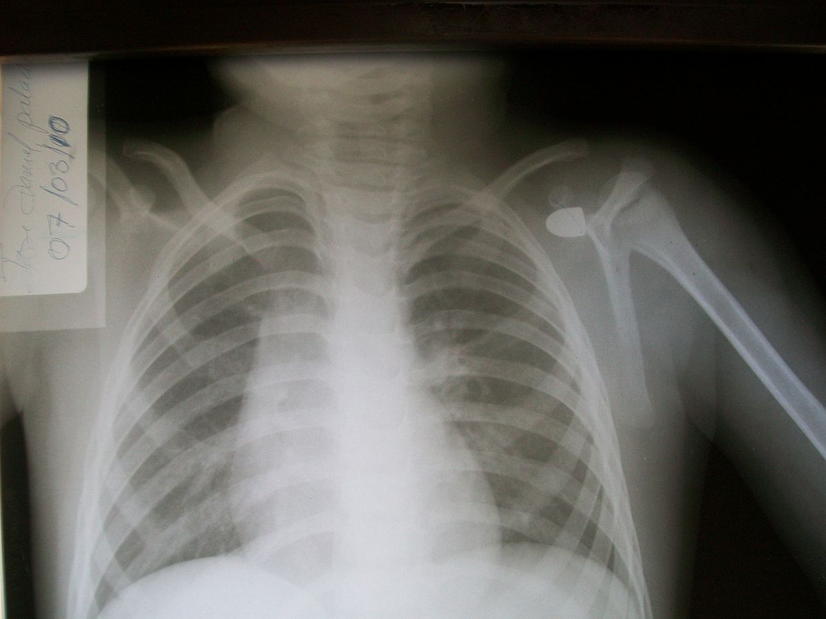Shoulder Popping, No Pain A Symptom Of Something Worse Or A Benign Condition? Cellaxys