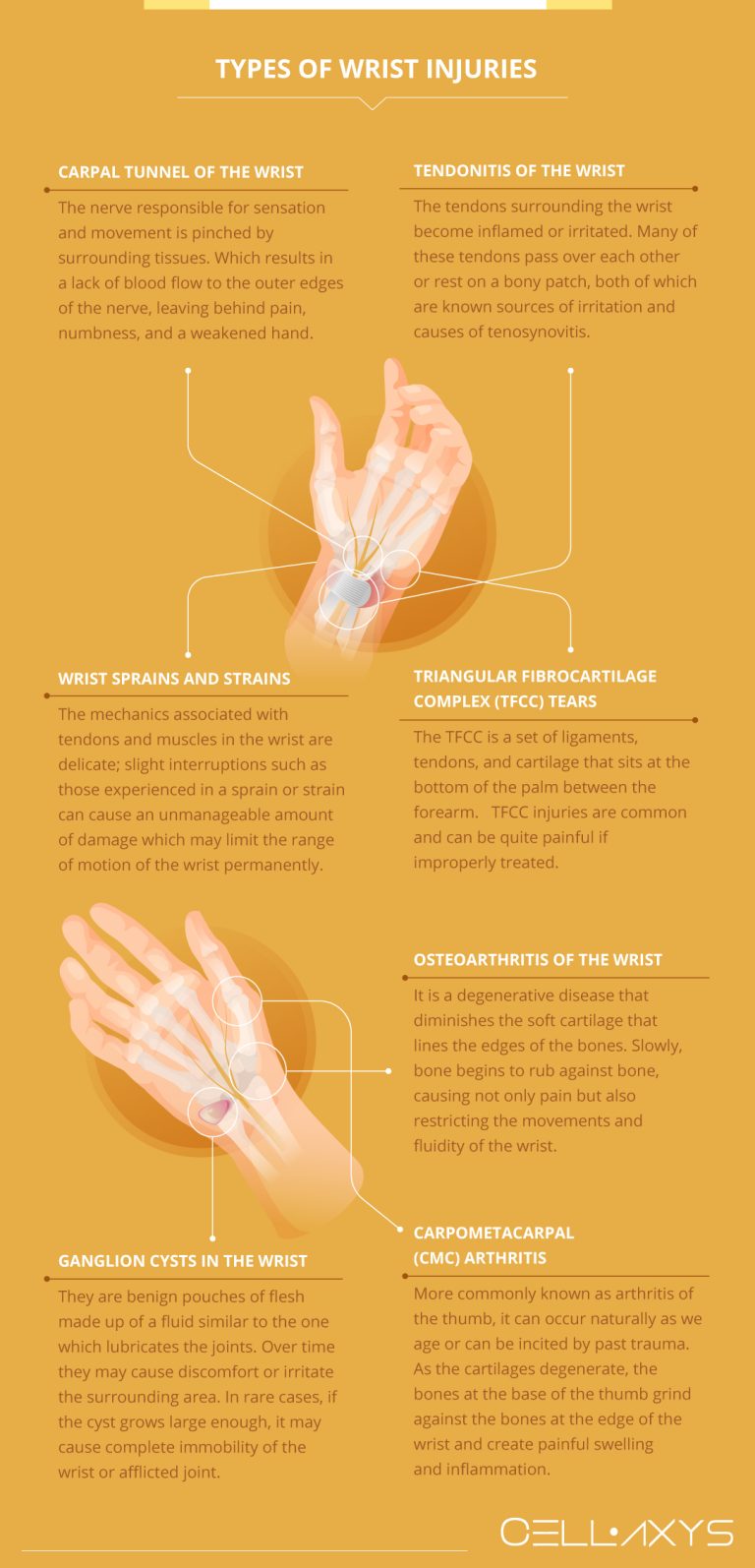 7 Most Common Wrist Injuries [Infographic] - Cellaxys