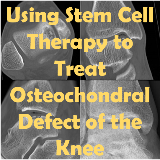 Osteochondral Defect of the Knee
