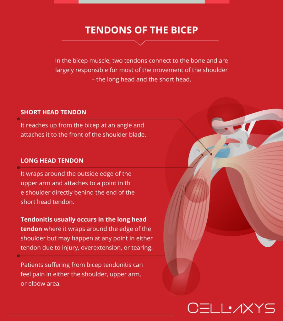 Bicep Tendonitis: Shoulder Pain And Treatment - Cellaxys