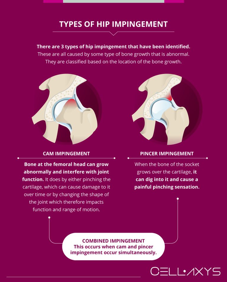 Can Regenerative Medicine Reduce Hip Impingement Surgery Recovery Time