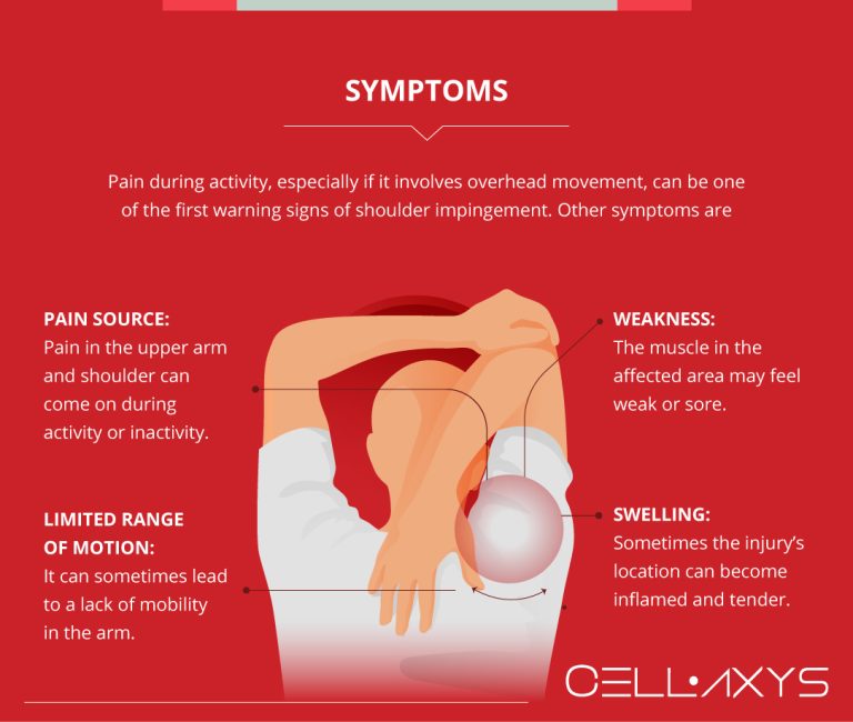 Shoulder Impingement Surgery Recovery Time - Cellaxys