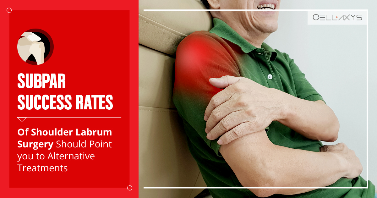 NonOperative Treatments To Shoulder Labrum Tear Using Your Own Body