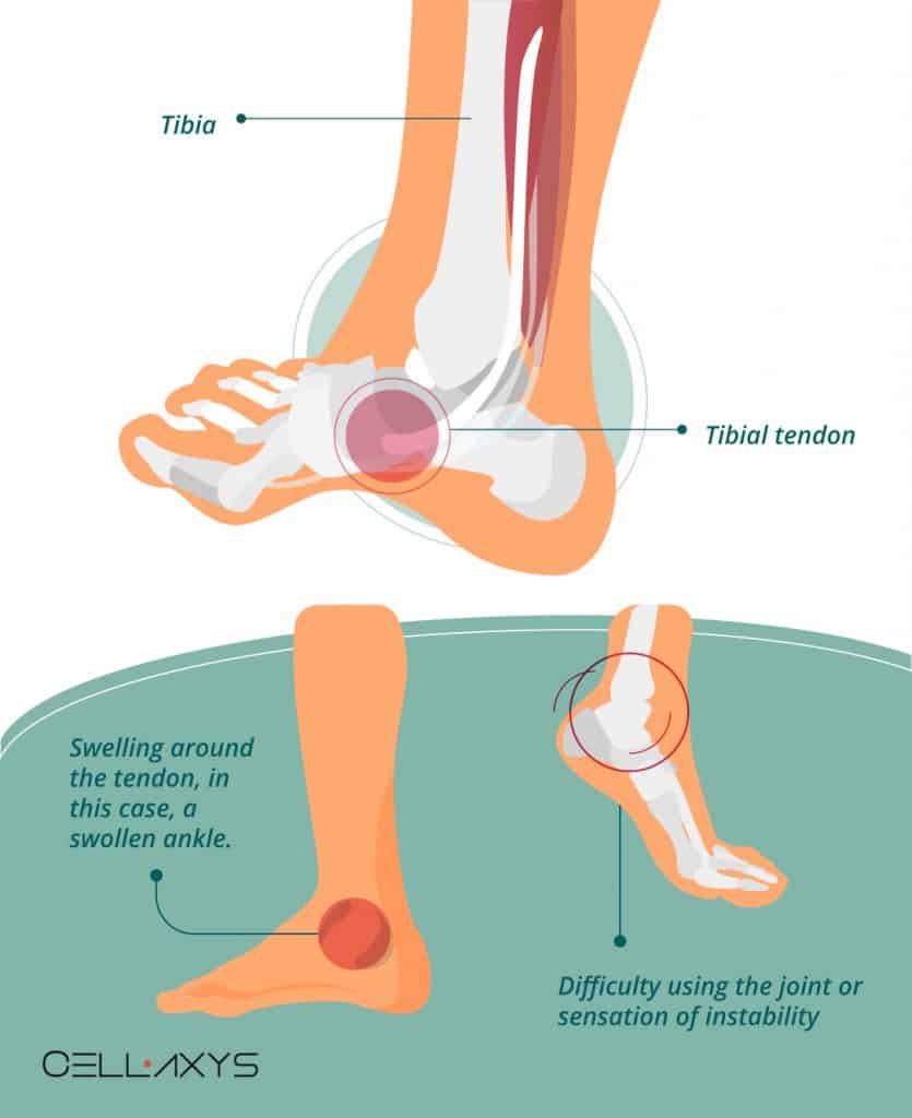 How To Decrease Your Posterior Tibial Tendonitis Recovery Time? - Cellaxys