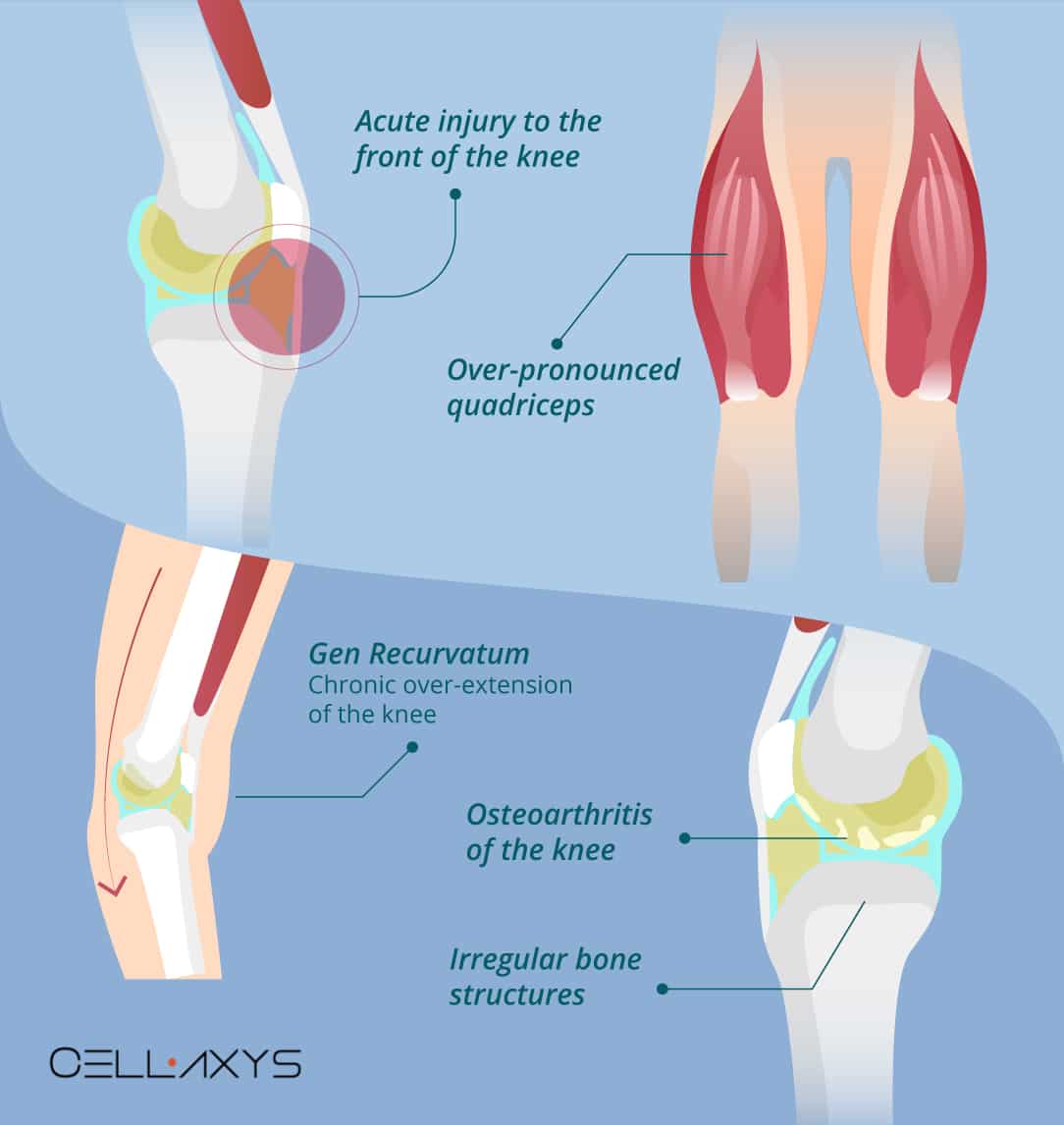 Causes of knee fat impidgement