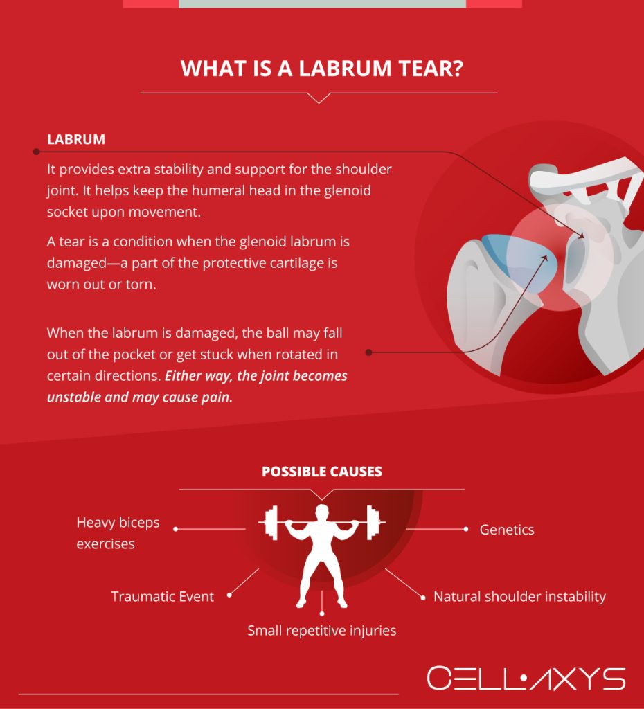 Do You Have A Labrum Tear? Cellaxys