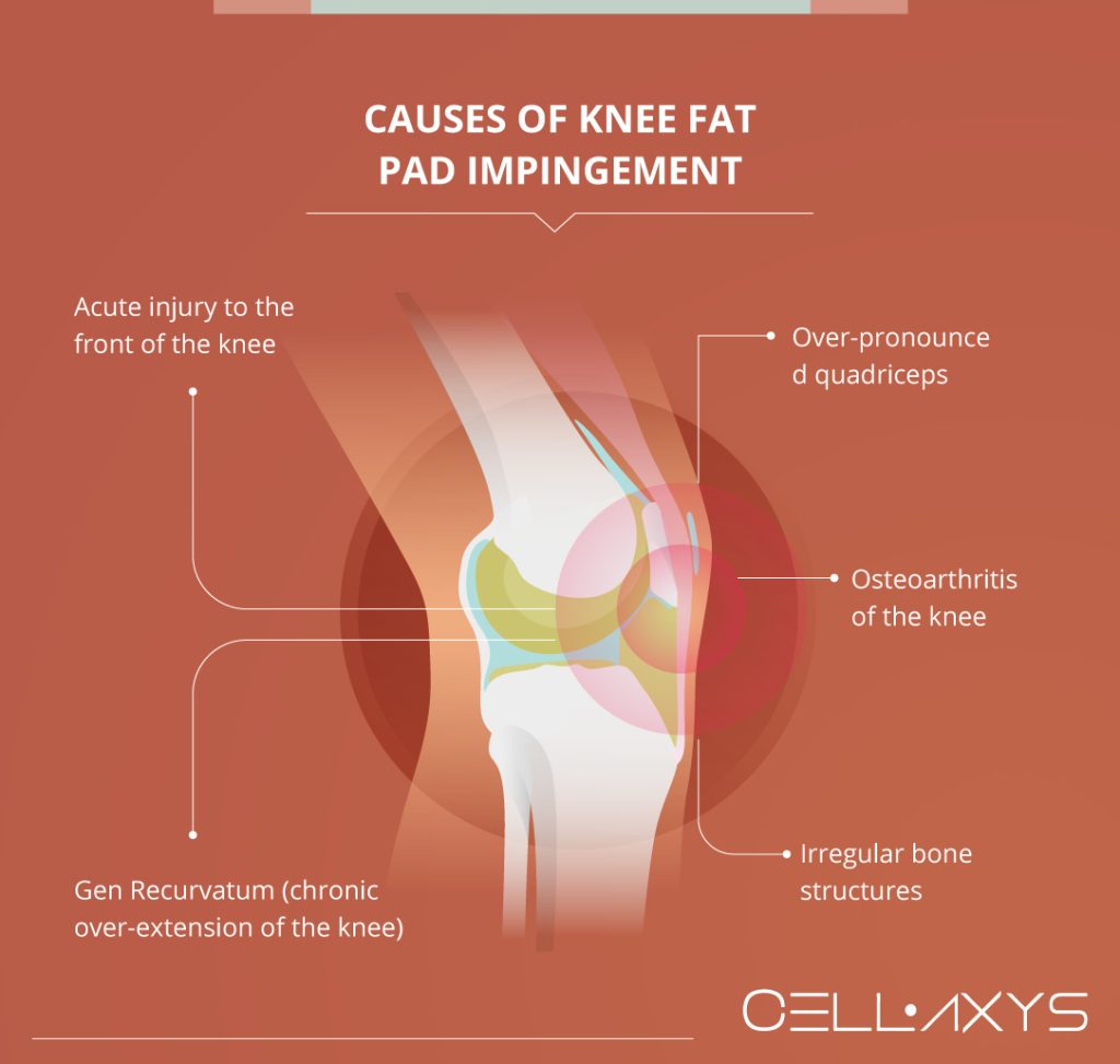 Knee Fat Pad Impingement Potential Cause Of Knee Pain Cellaxys