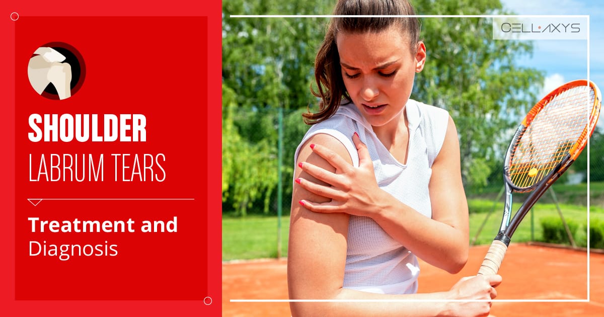 Shoulder Labrum Tears: Treatment And Diagnosis - Cellaxys