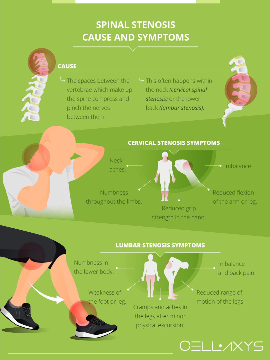 Six Signs of Spinal Stenosis