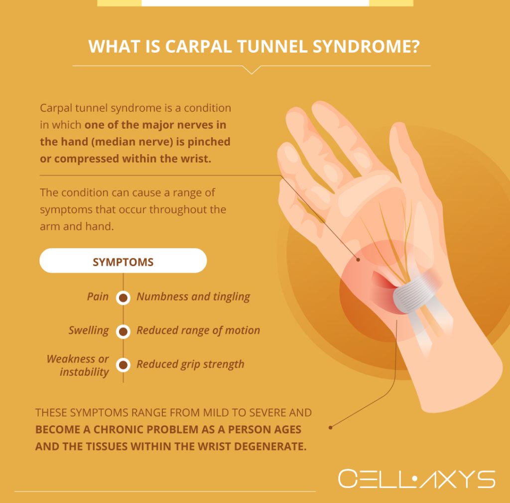 Is Surgery Right For My Carpal Tunnel? Regenerative Therapy Begs To ...