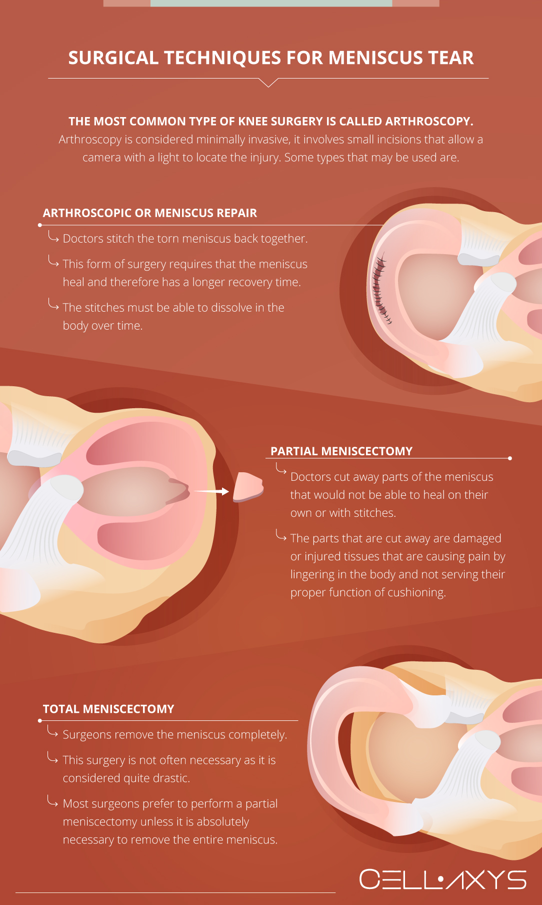 Treatment Strategies For Meniscus Tears And Their Alternatives Cellaxys Treatment Strategies For Meniscus Tears And Their Alternatives Cellaxys