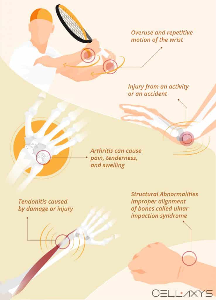 How To Manage UlnarSided Wrist Pain With A Brace? Cellaxys