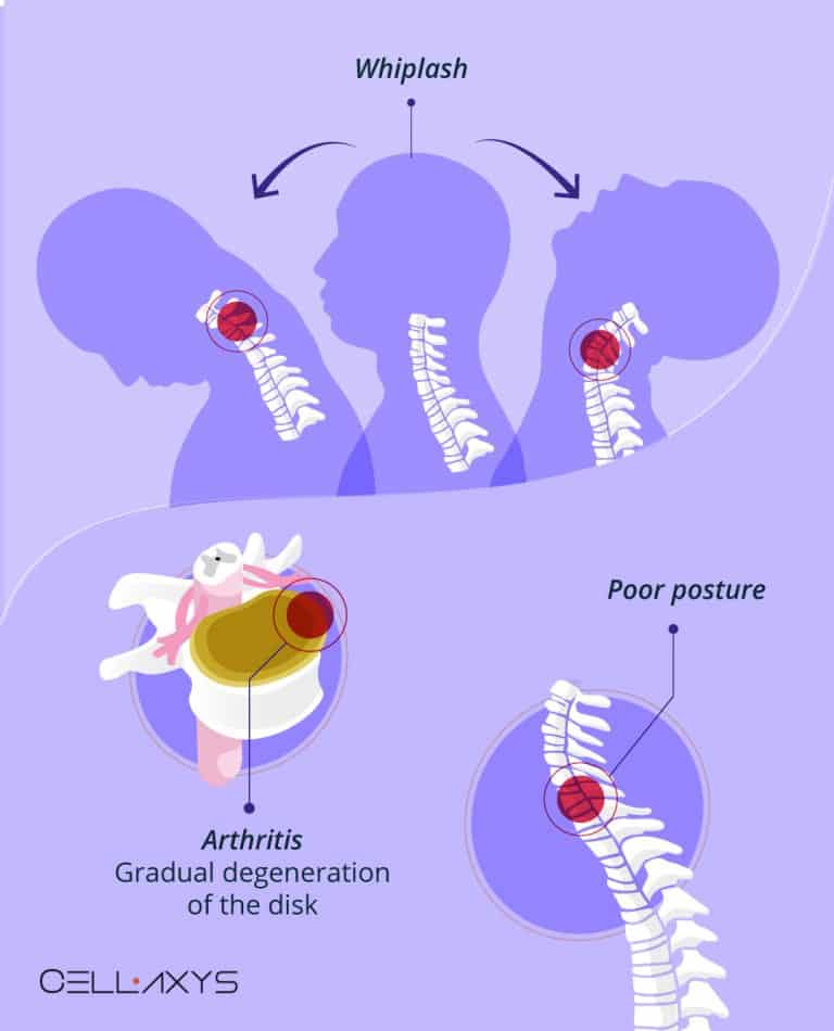 A Stiff Neck & A Weak Stomach How Neck Pain Can Cause Nausea? Cellaxys
