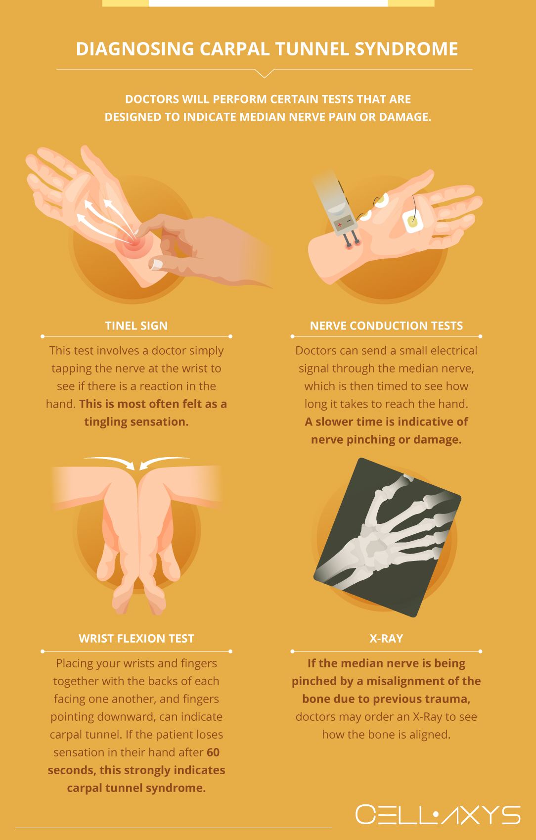 Carpal Tunnel Surgery [Full Guide With Infographic] - Cellaxys