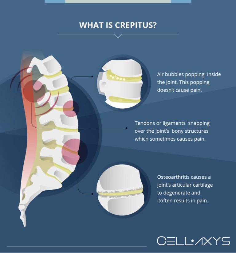 Causes Of Popping Noise In The Lower Back - Cellaxys