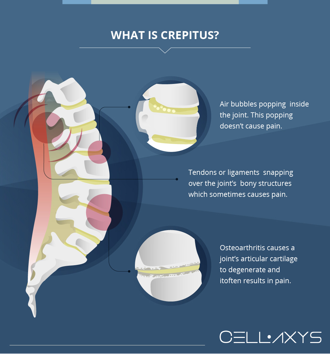 What is Crepitus