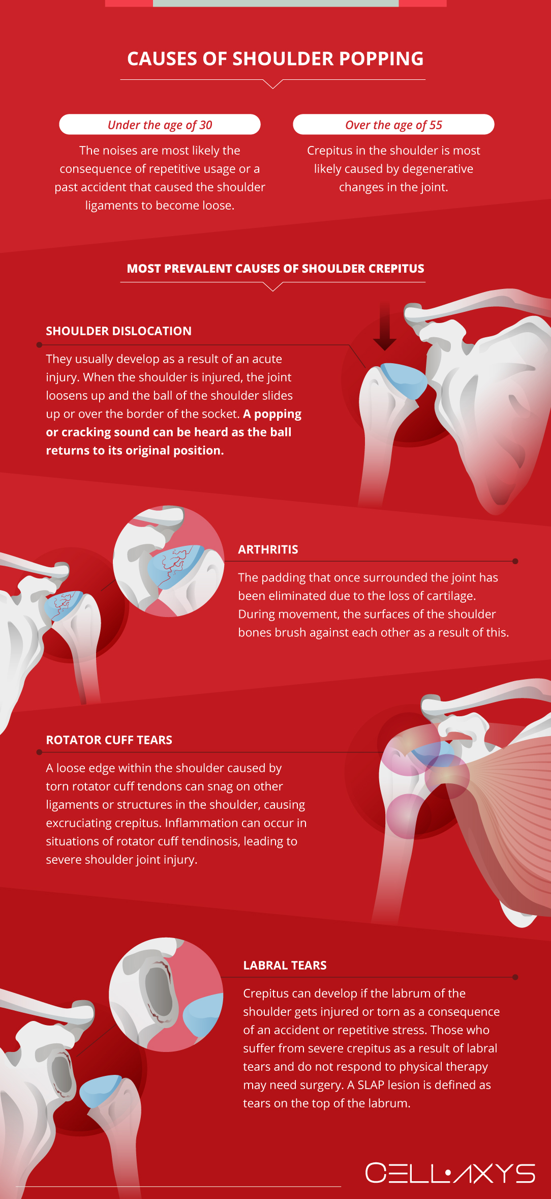 Causes of Shoulder Popping