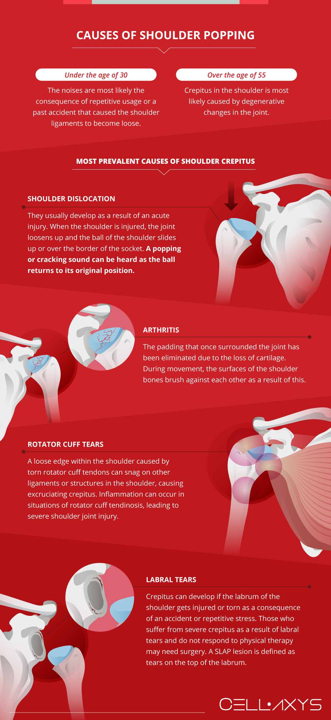 Shoulder Popping, No Pain – A Symptom Of Something Worse Or A Benign  Condition? - Cellaxys