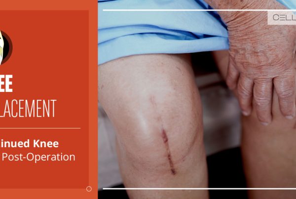 Knee Replacement: Continued Knee Pain Post-Operation