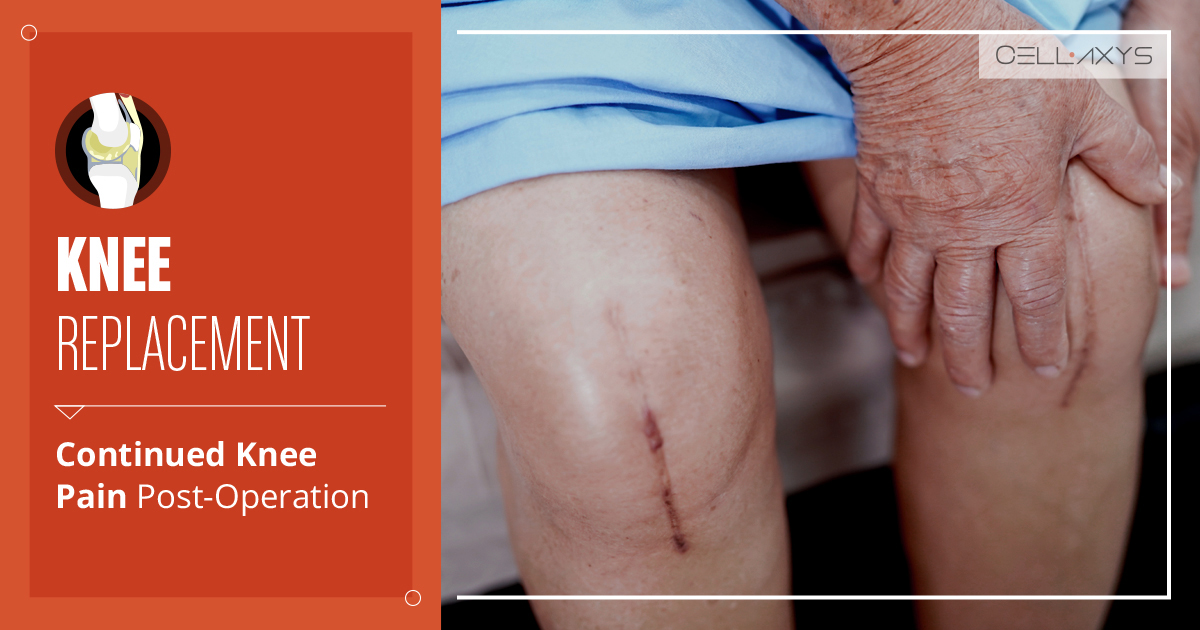Knee Replacement: Continued Knee Pain Post-Operation