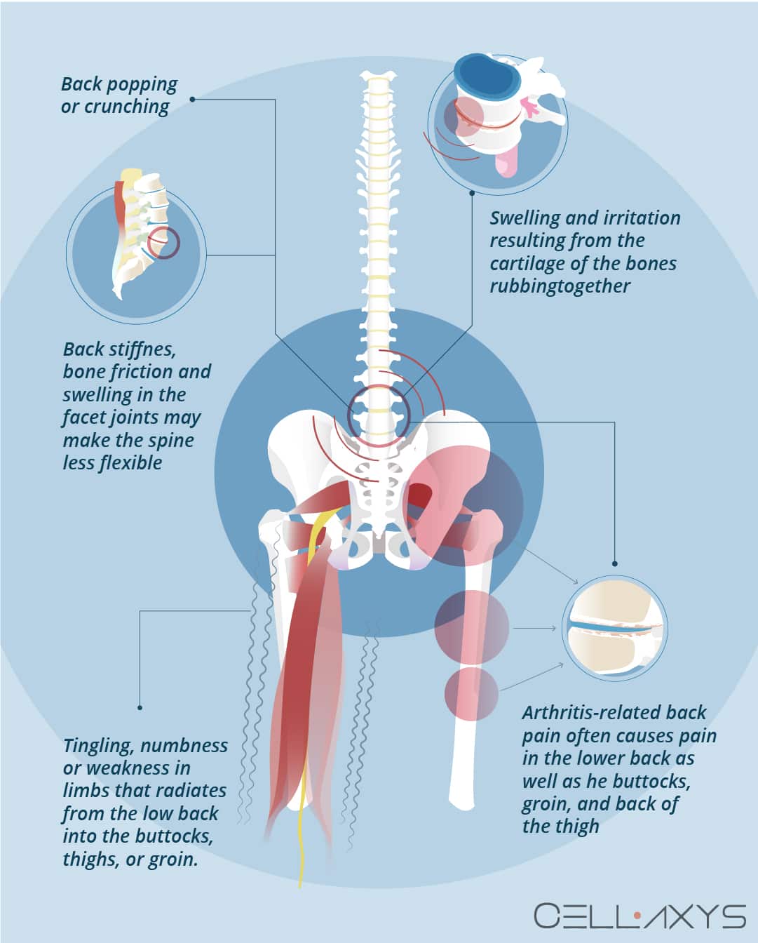 Osteoartrite com ruído de popping lombar