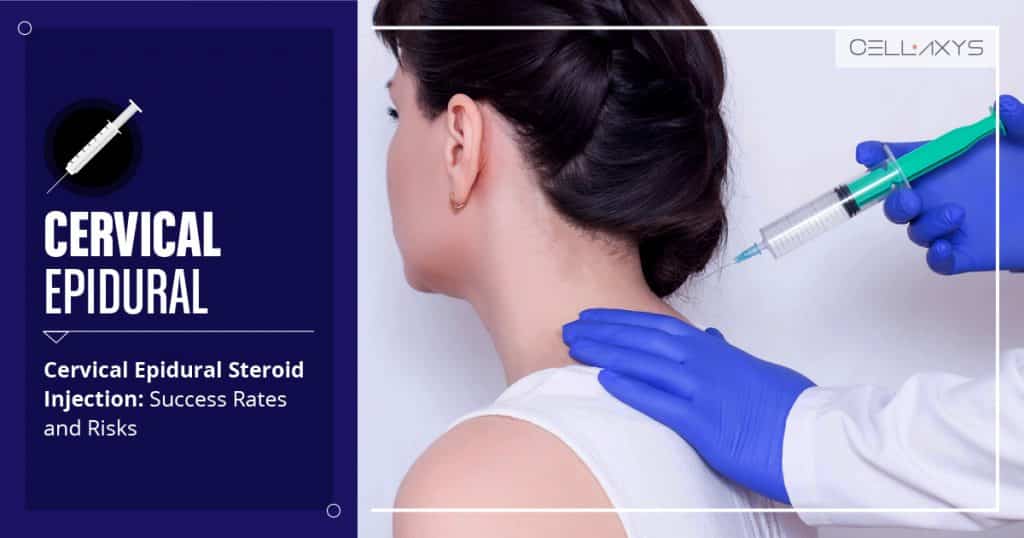 Cervical Epidural Steroid Injection: Success Rates and Risks