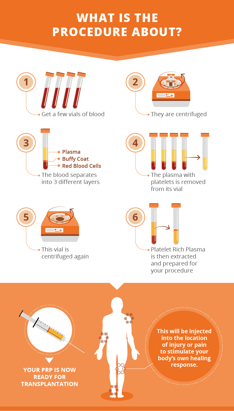 The Platelet Rich Plasma Procedure