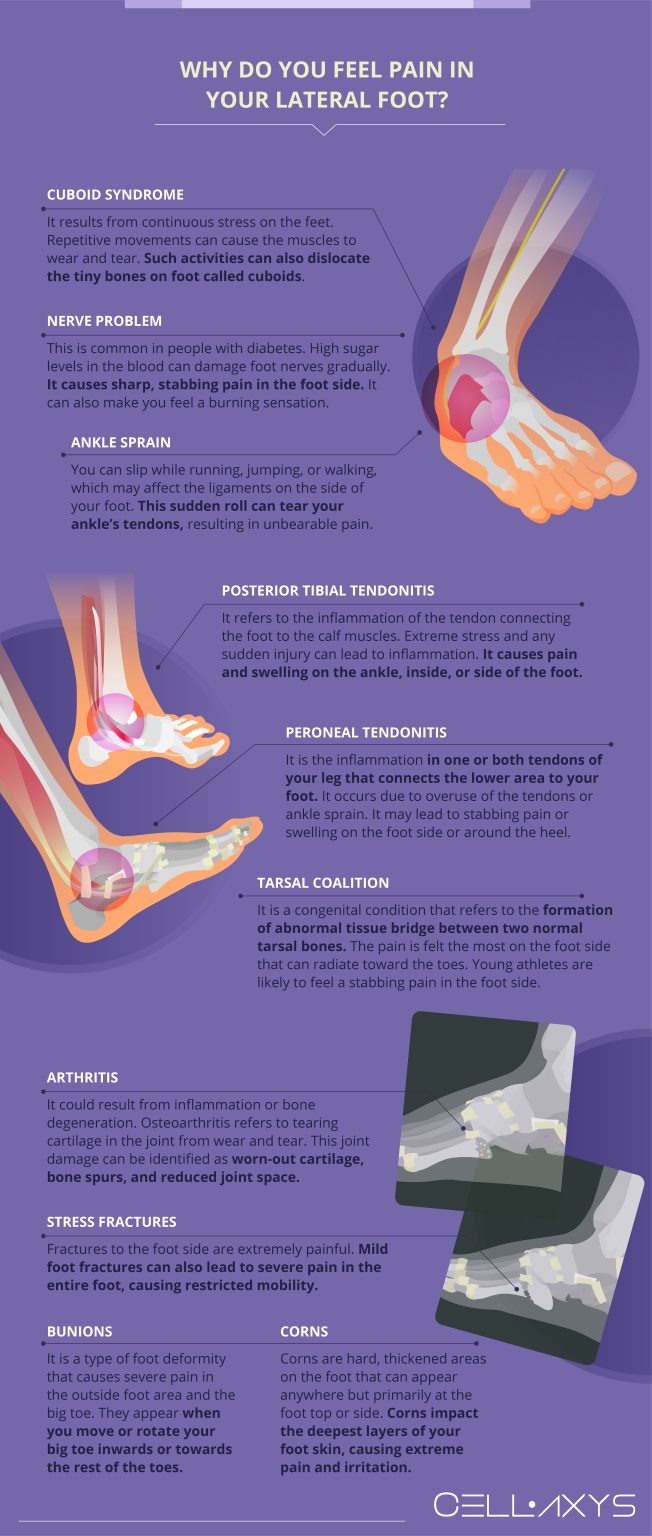 10 Causes Of Stabbing Pain In Foot Side - Cellaxys