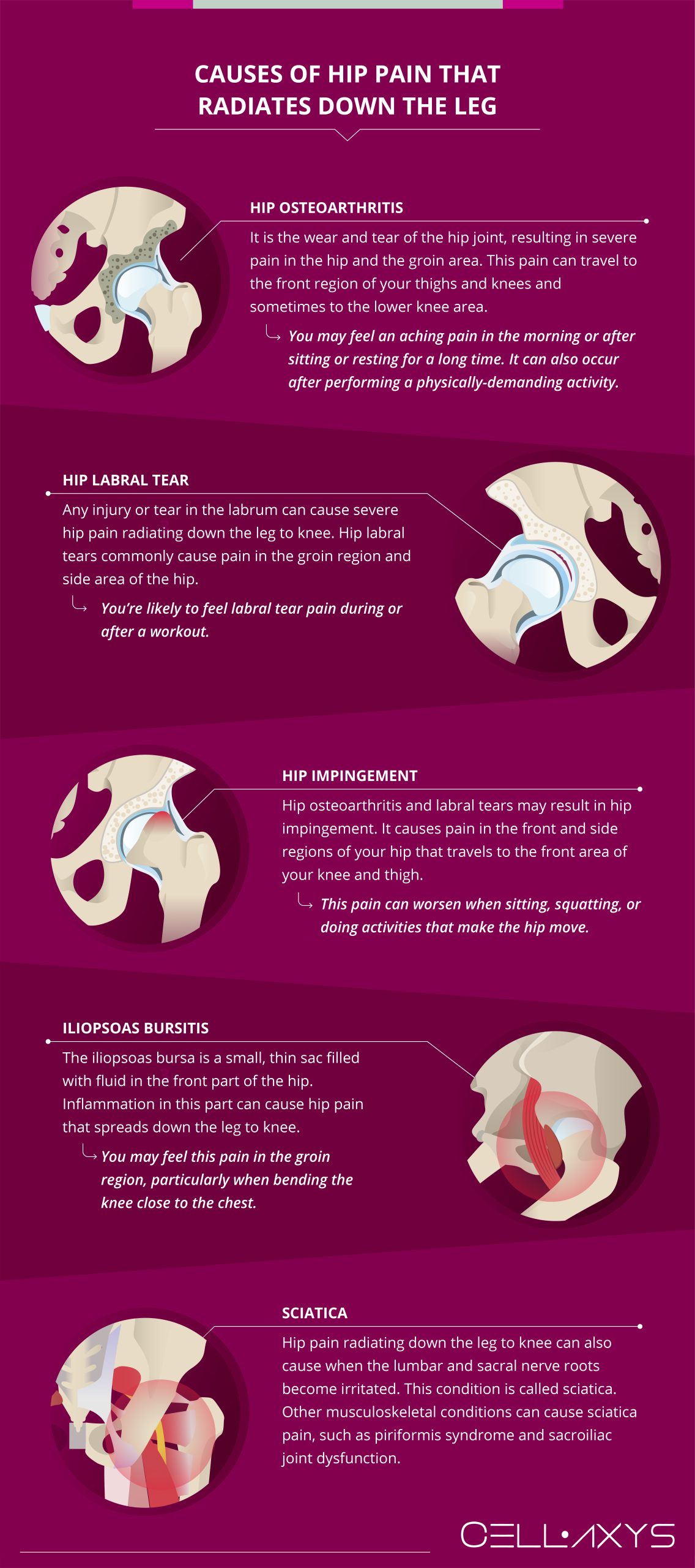 Hip Pain Radiating Down The Leg To Knee - Cellaxys