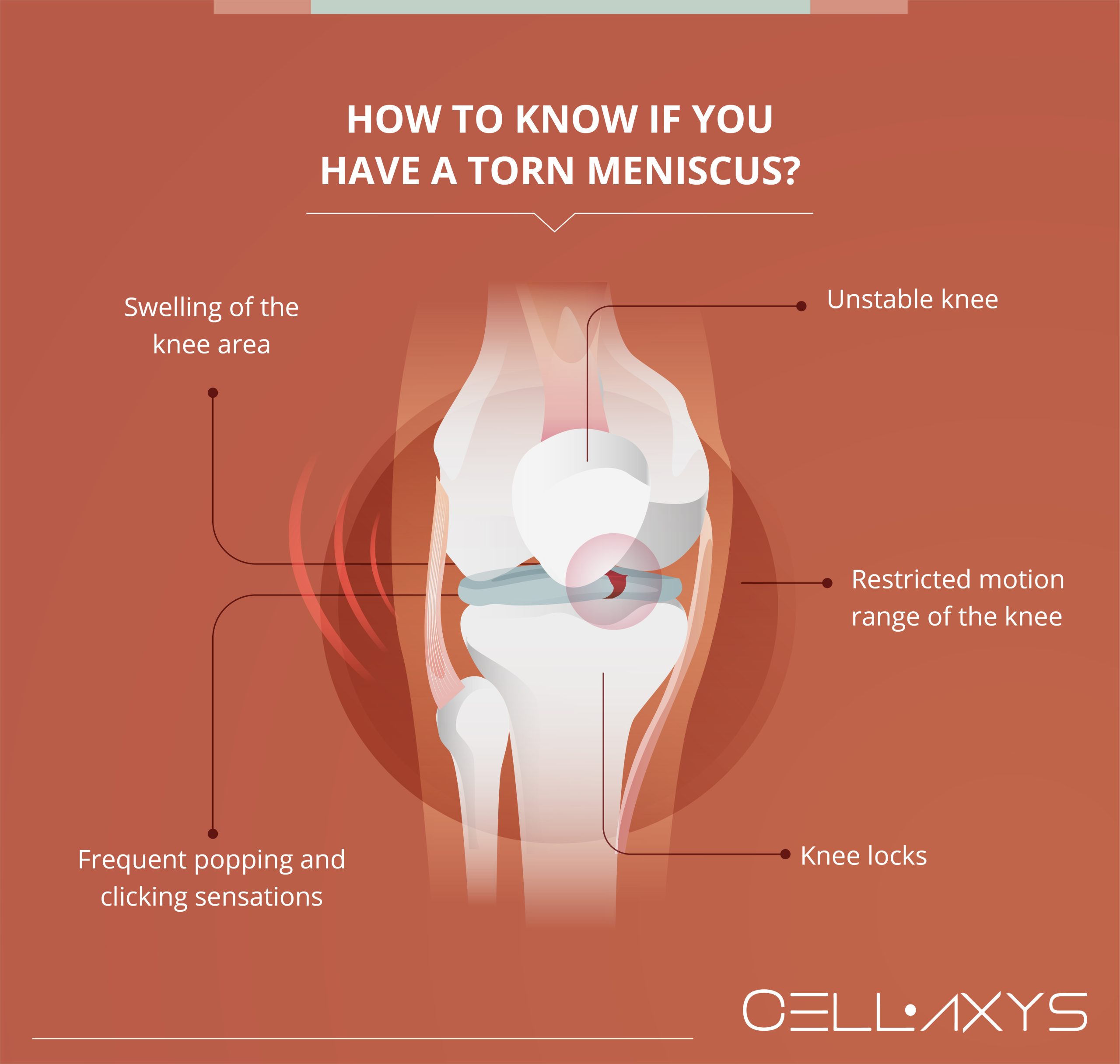 How To Heal A Torn Meniscus Naturally Cellaxys 