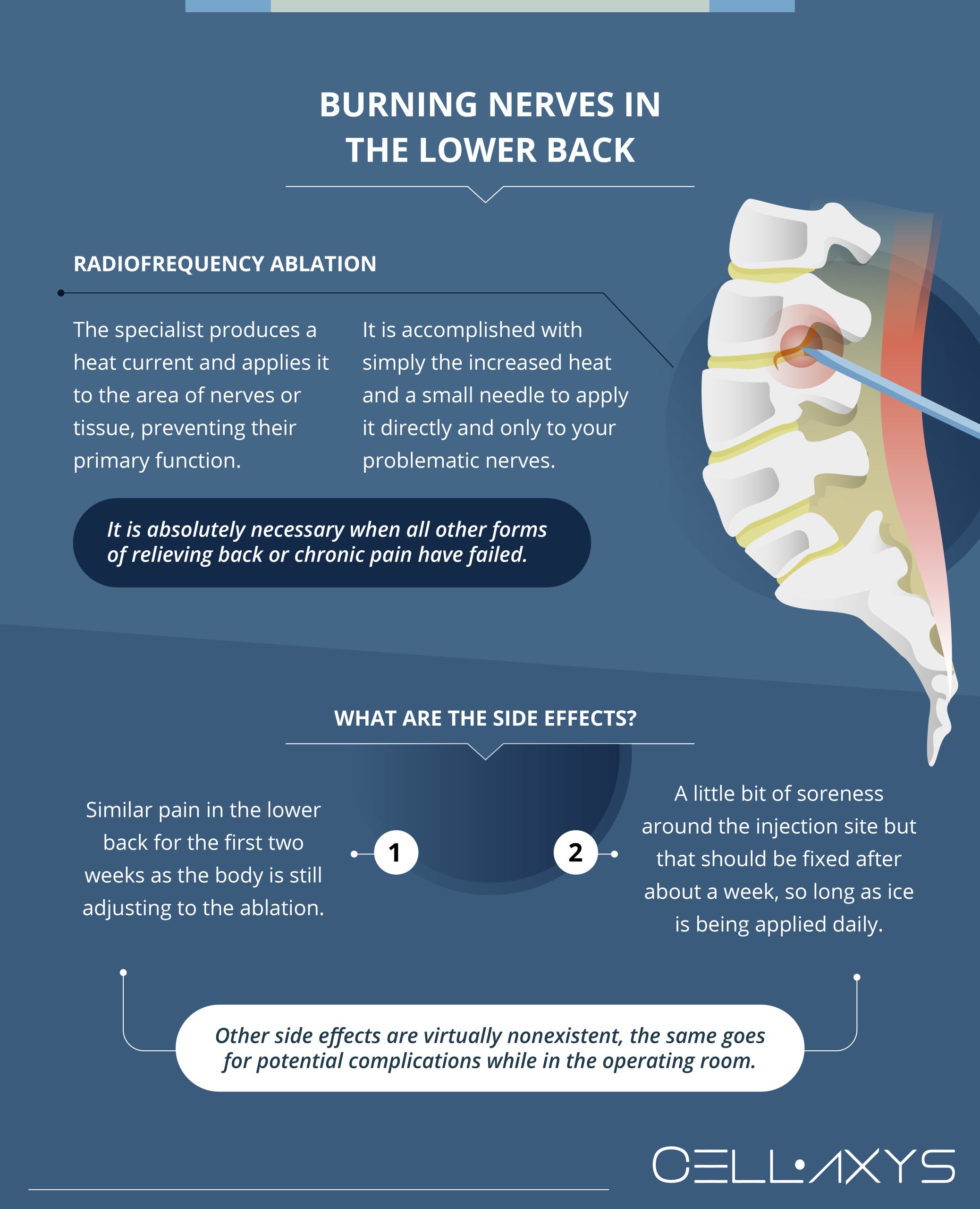 Risk of Burning Nerves in the Lower Back