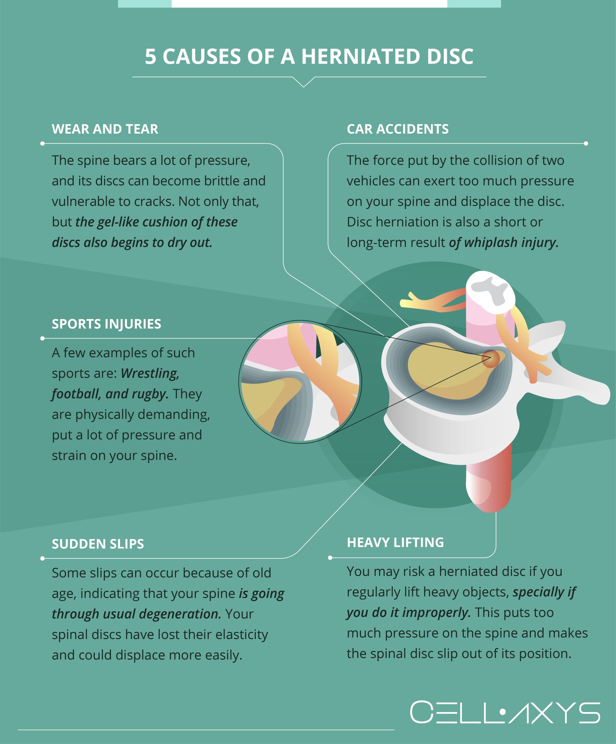 Causes of a Herniated Disc