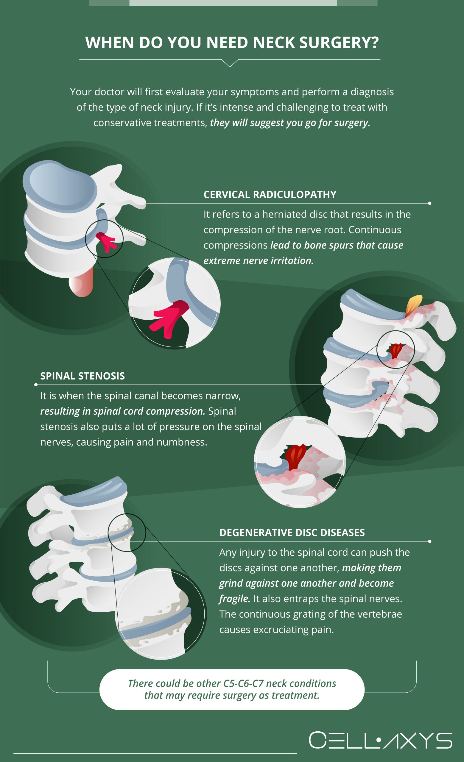 When is surgery needed for C5-C6?