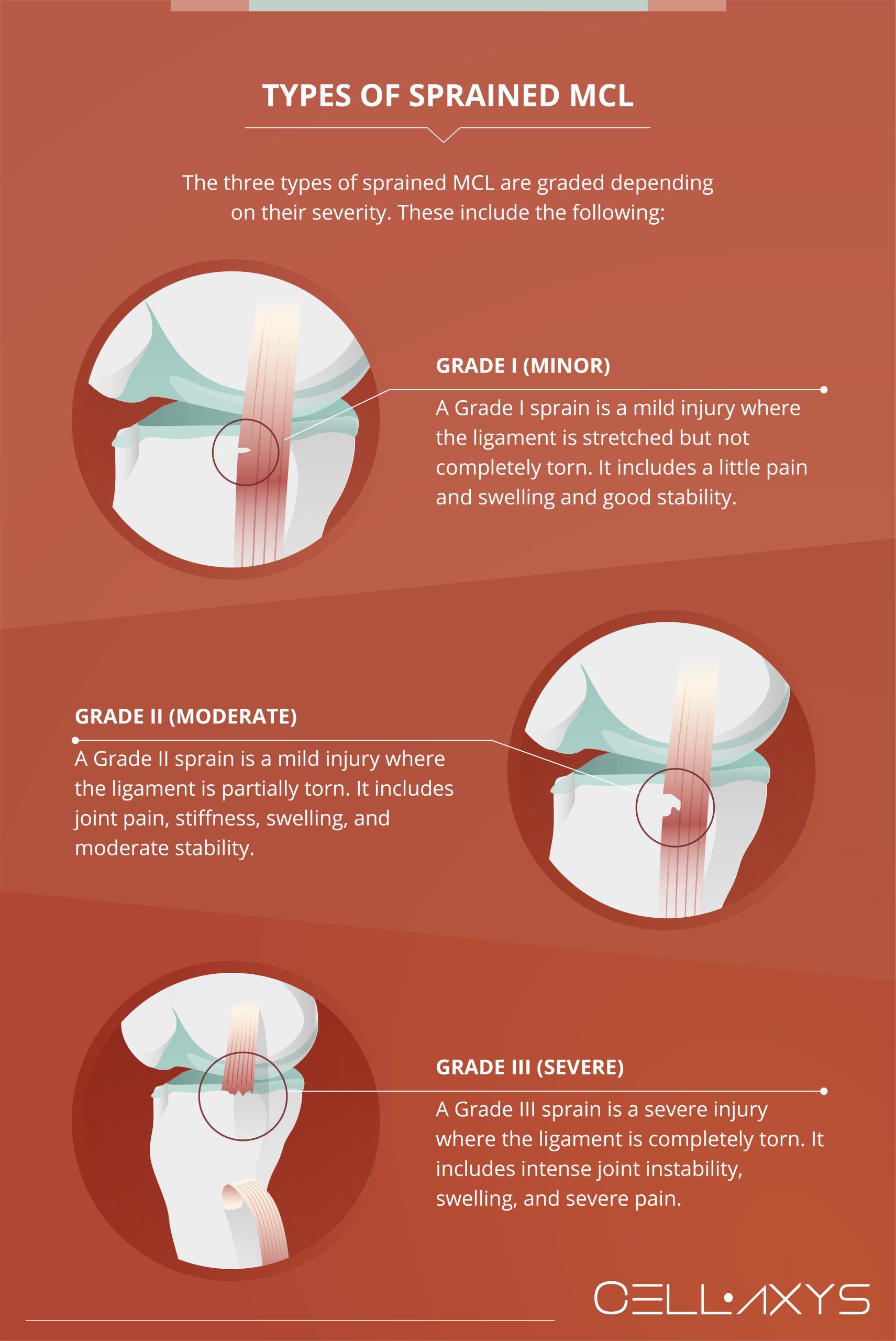 Symptoms of MCL Sprains and Tears