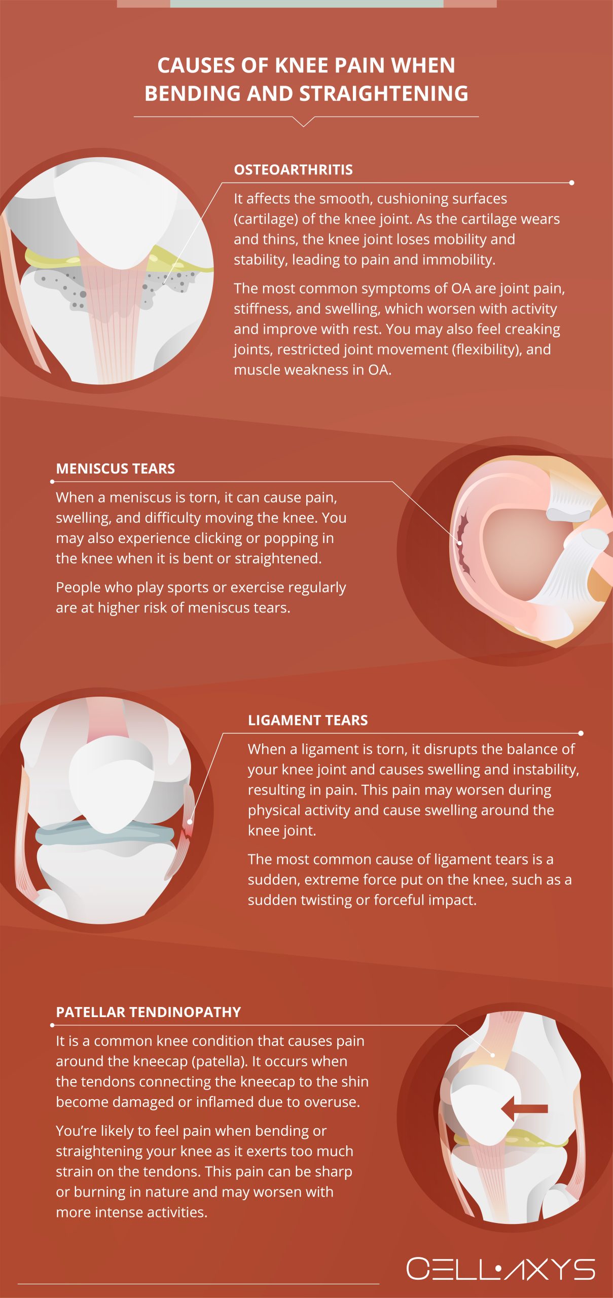 Causes of Knee Pain When Bending and Straightening 