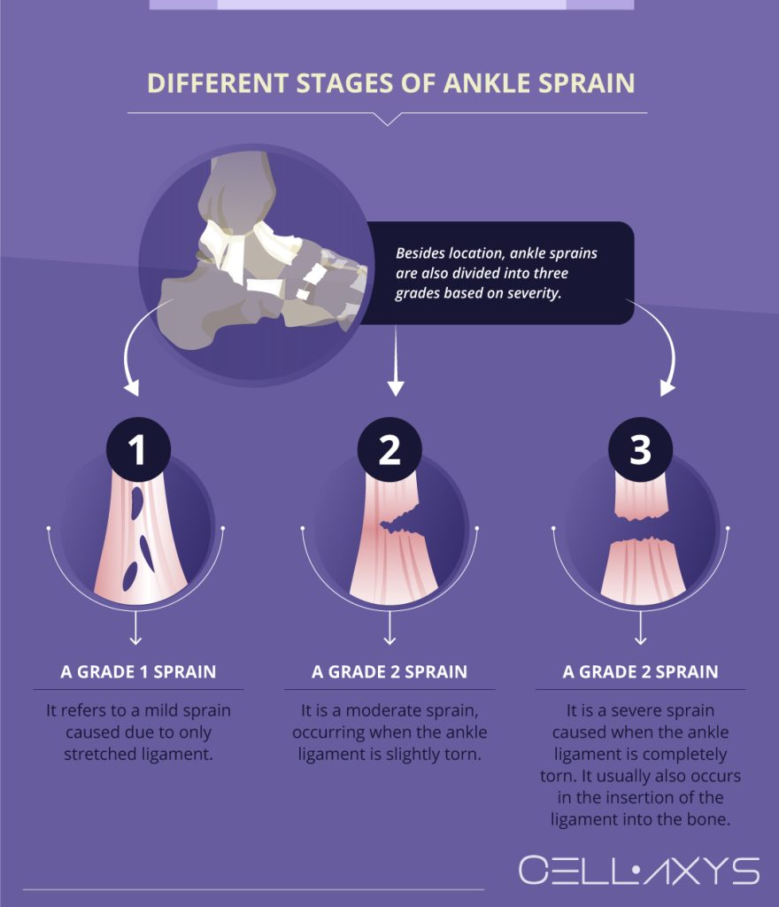 How Long Does A Sprained Ankle Stay Swollen Cellaxys 3957