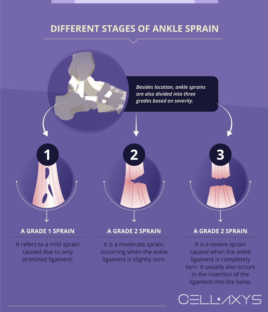 Different Stages of Ankle Sprain