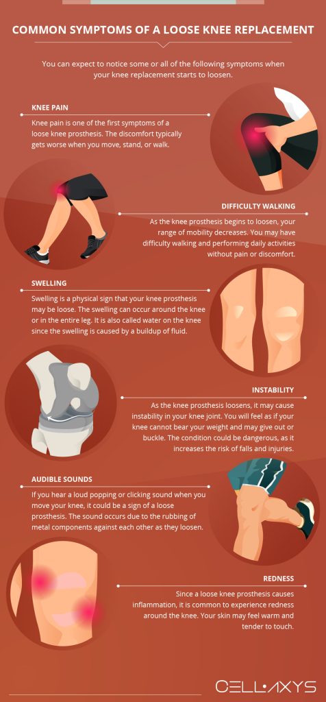 Symptoms Of A Loose Knee Replacement - Cellaxys