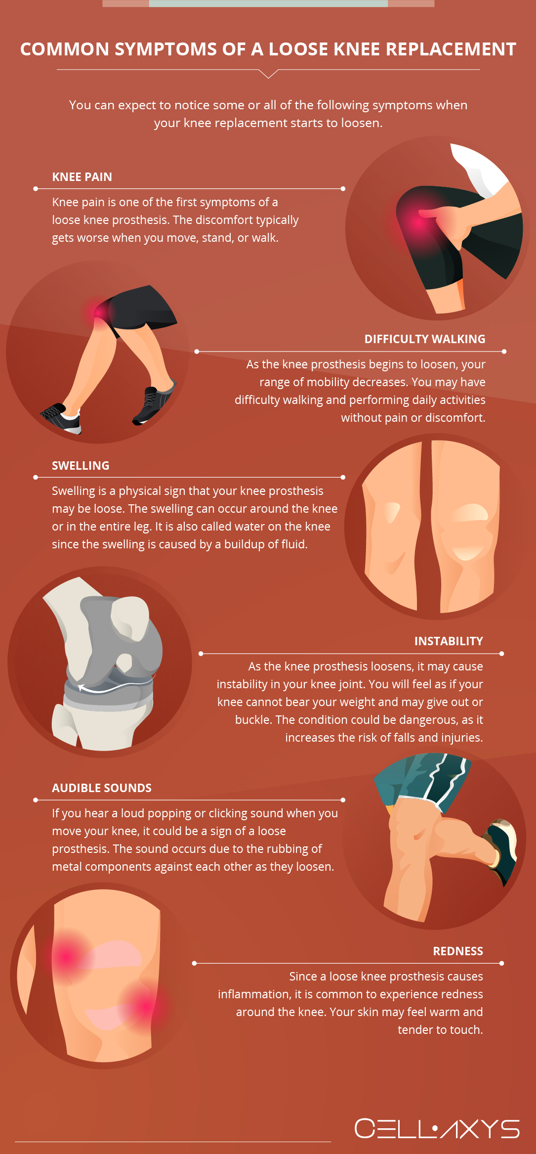 Common Symptoms of a Loose Knee Replacement 